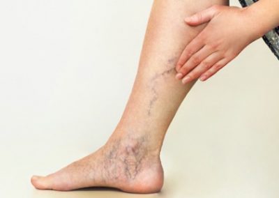 Venous Insufficiency