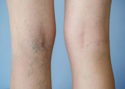 Venous Insufficiency