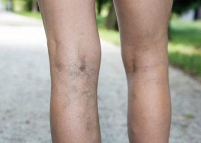 Venous Insufficiency