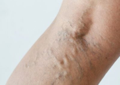 Venous Insufficiency