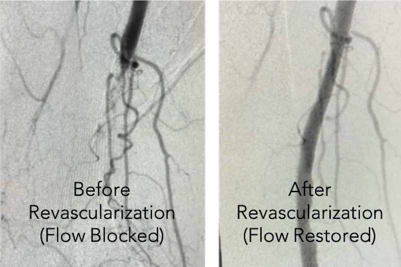 Peripheral artery disease before and after arterial revascularization