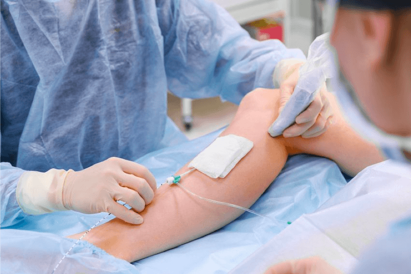 Vein treatment with foam sclerotherapy