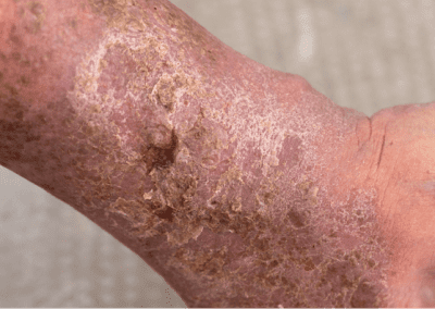 Venous ulcer picture