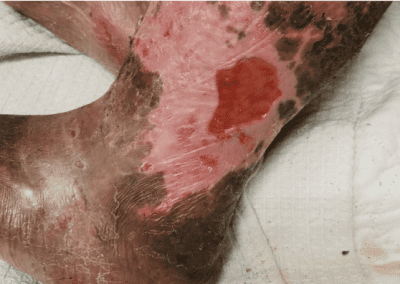 Venous ulcer picture