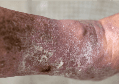 Venous ulcer picture