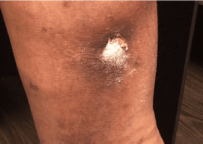 Venous ulcer picture