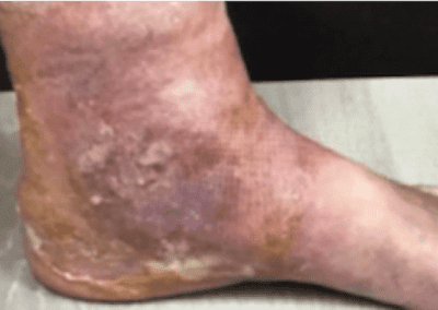 Venous ulcer picture
