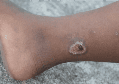 Venous ulcer picture