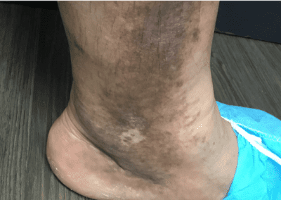 Venous ulcer picture