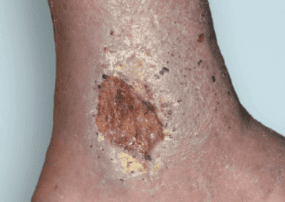 Venous ulcer picture