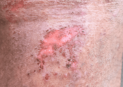 Venous ulcer picture