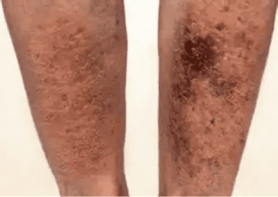 Venous ulcer picture