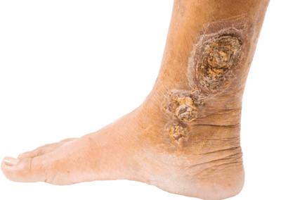 Venous ulcer picture