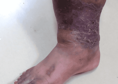 Venous ulcer picture
