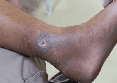 Venous ulcer picture