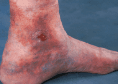 Venous ulcer picture