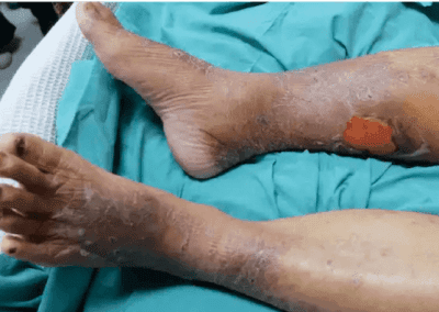 Venous ulcer picture