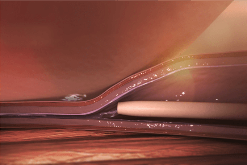Explanatory VenaSeal procedure graphic