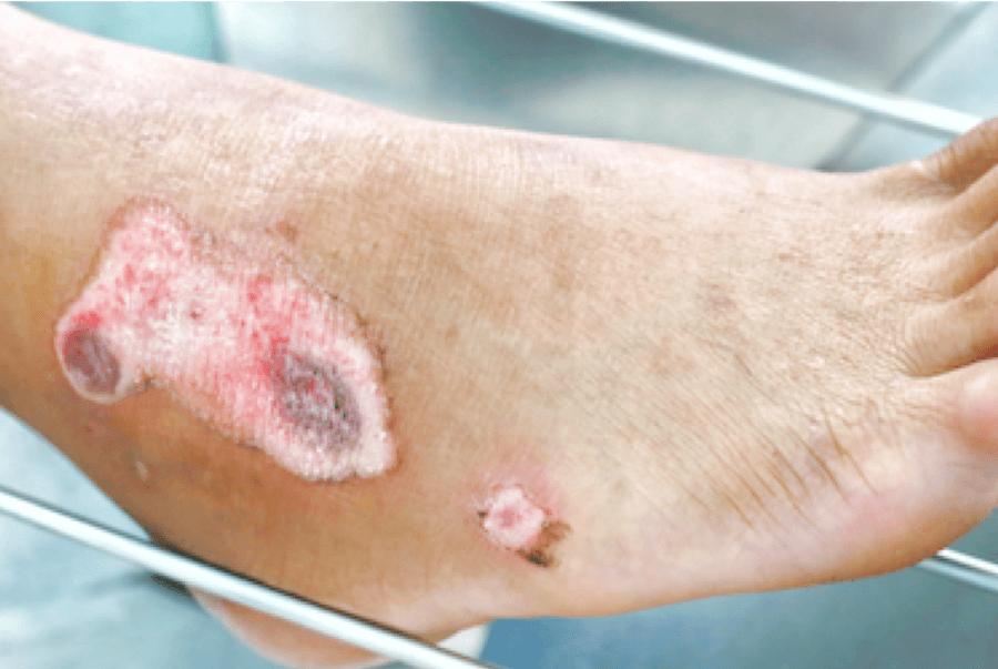 Arterial wounds on foot healing after treatment