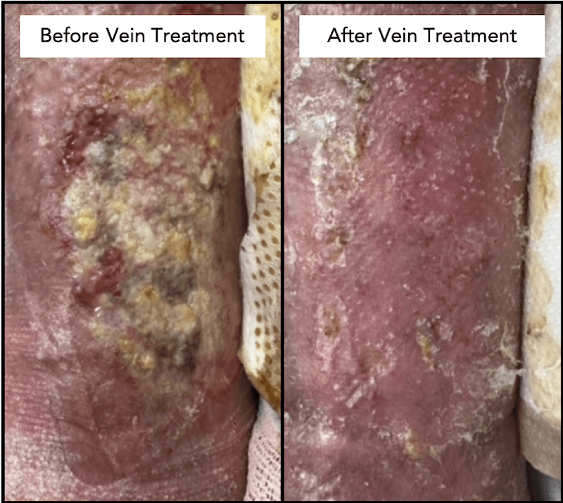 Before and after venous wound treatment