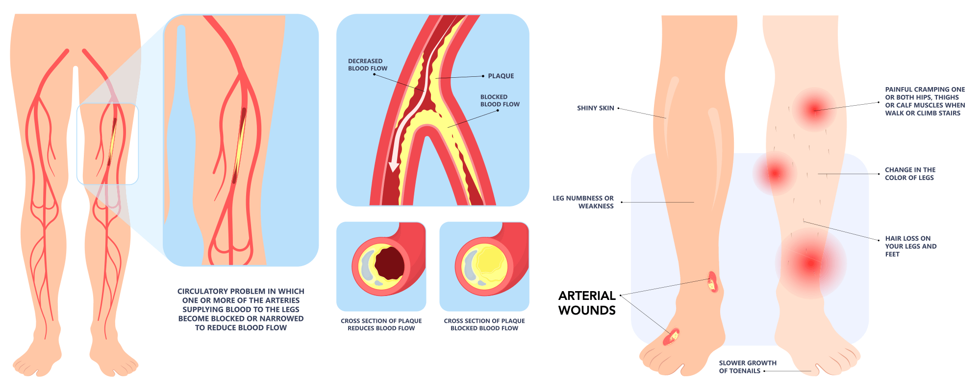 Arterial wound causes diagram