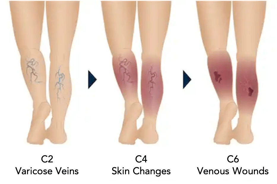 Venous insufficiency progression from varicose veins to venous wounds