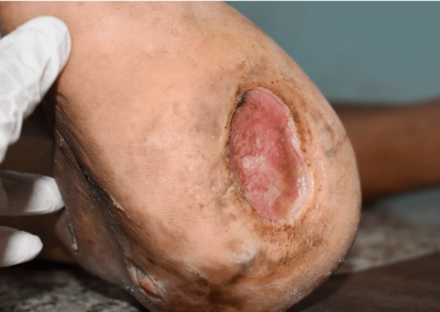 Arterial Ulcer Picture