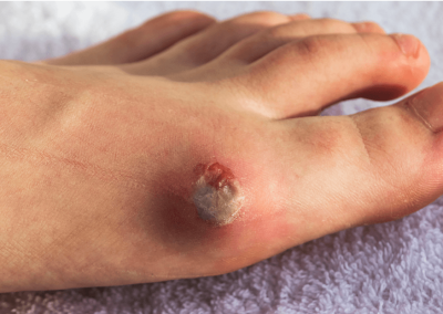 Arterial Ulcer Picture