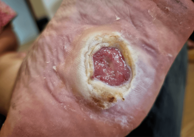 Arterial Ulcer Picture