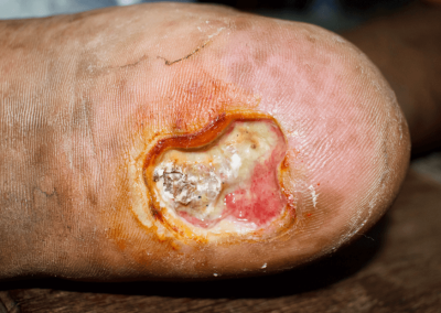 Arterial Ulcer Picture