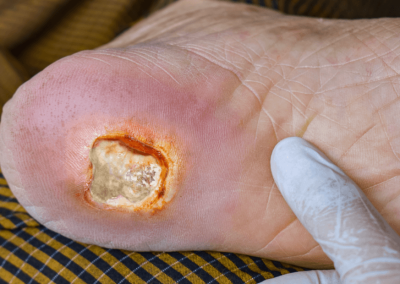 Arterial Ulcer Picture