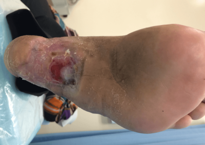 Arterial Ulcer Picture
