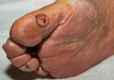Arterial Ulcer Picture