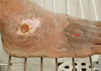 Arterial Ulcer Picture