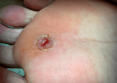 Arterial Ulcer Picture