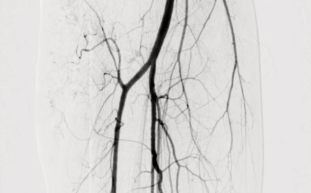Imaging for endovascular arterial revascularization