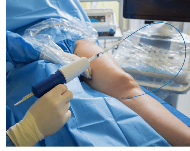 VenaSeal treatment in Los Angeles