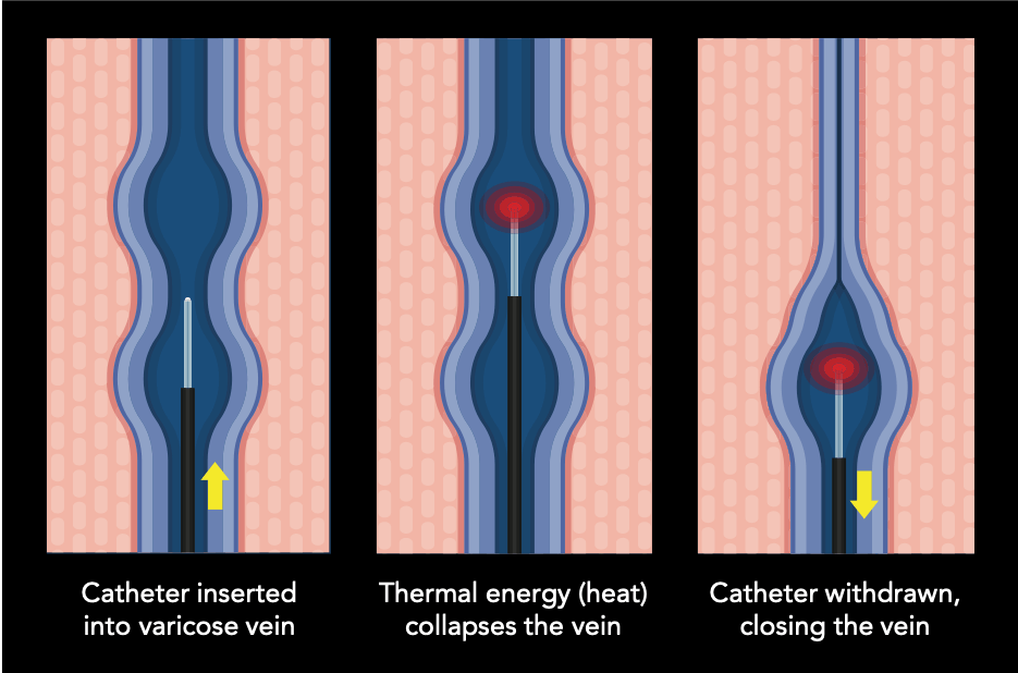 Radiofrequency vein ablation explanatory diagra