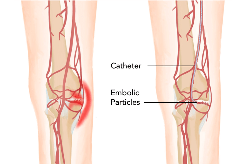 Genicular artery embolization diagram explanation