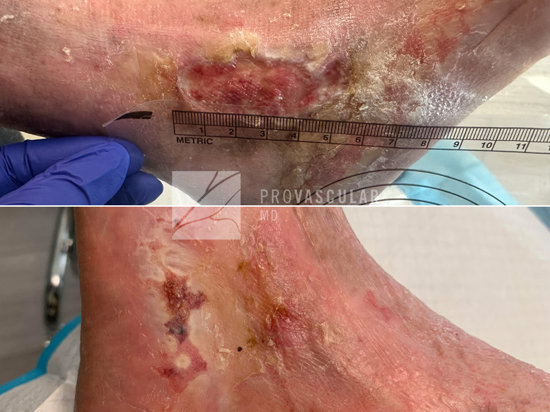 Rght Ankle Wound Before And After Image