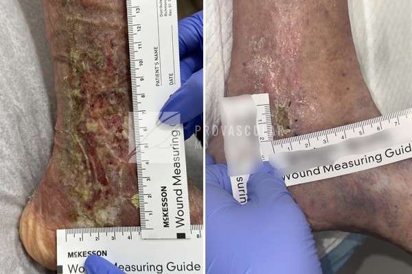 Vascular Wound Care Before And After Image