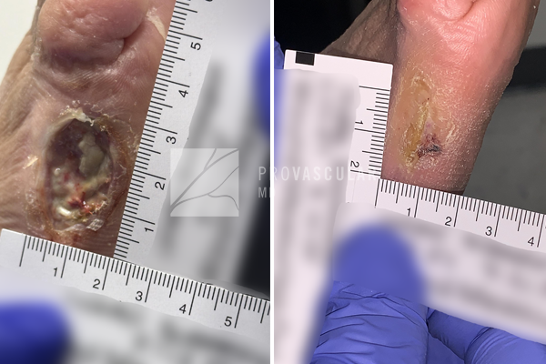 Wound care before after images