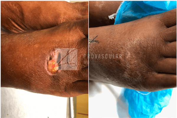 arterial wound before after