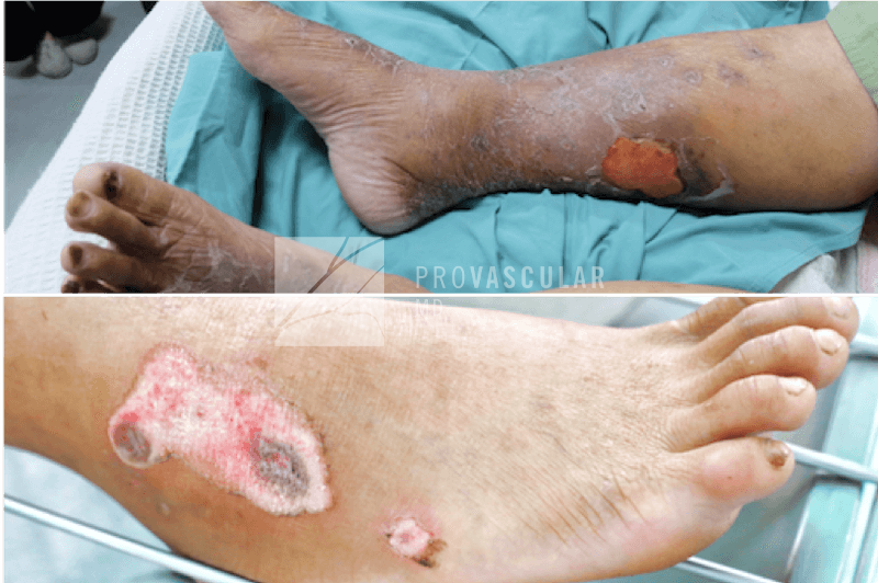 provascular arterial vs venous ulcer