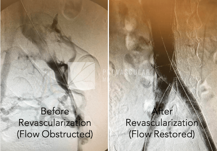wound revascularization before after