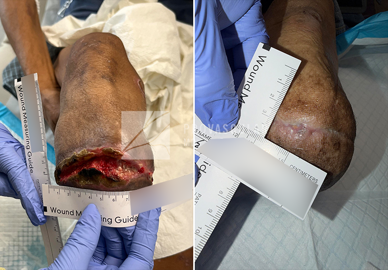 specialty wound care before after image specialty wound care before after image