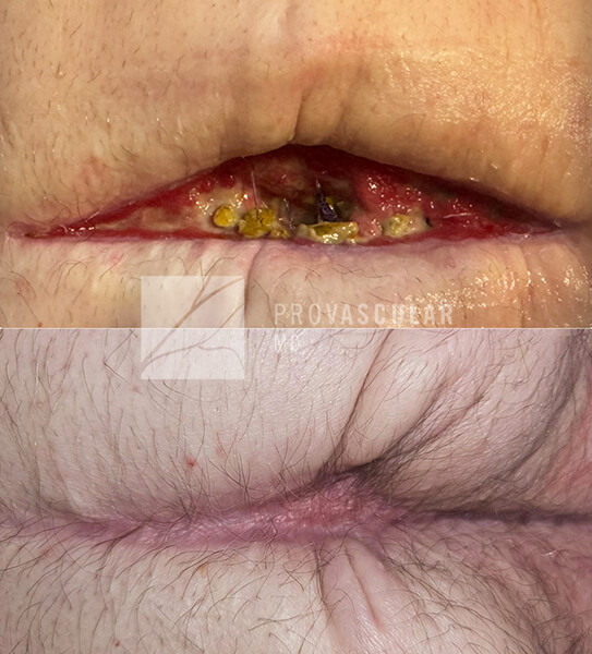 collage_export (1) specialty wound care before after image