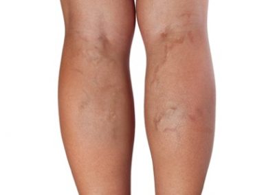 Venous Insufficiency