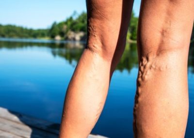 Venous Insufficiency