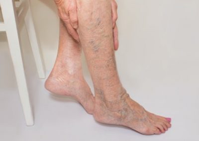 Venous Insufficiency